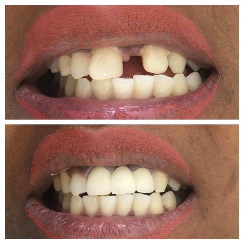 Missing tooth replaced with dental implants before and after in Indirapuram