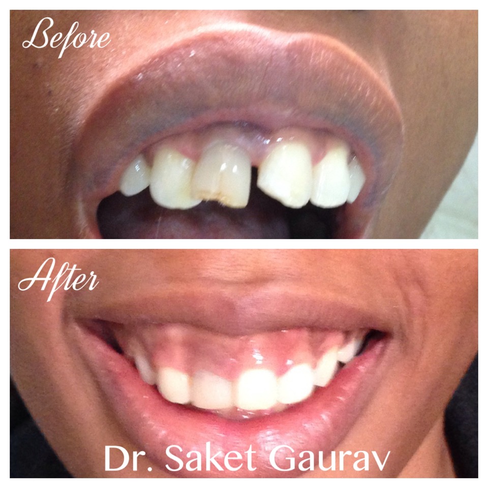 Painless root canal procedure by the best dentist in Ghaziabad