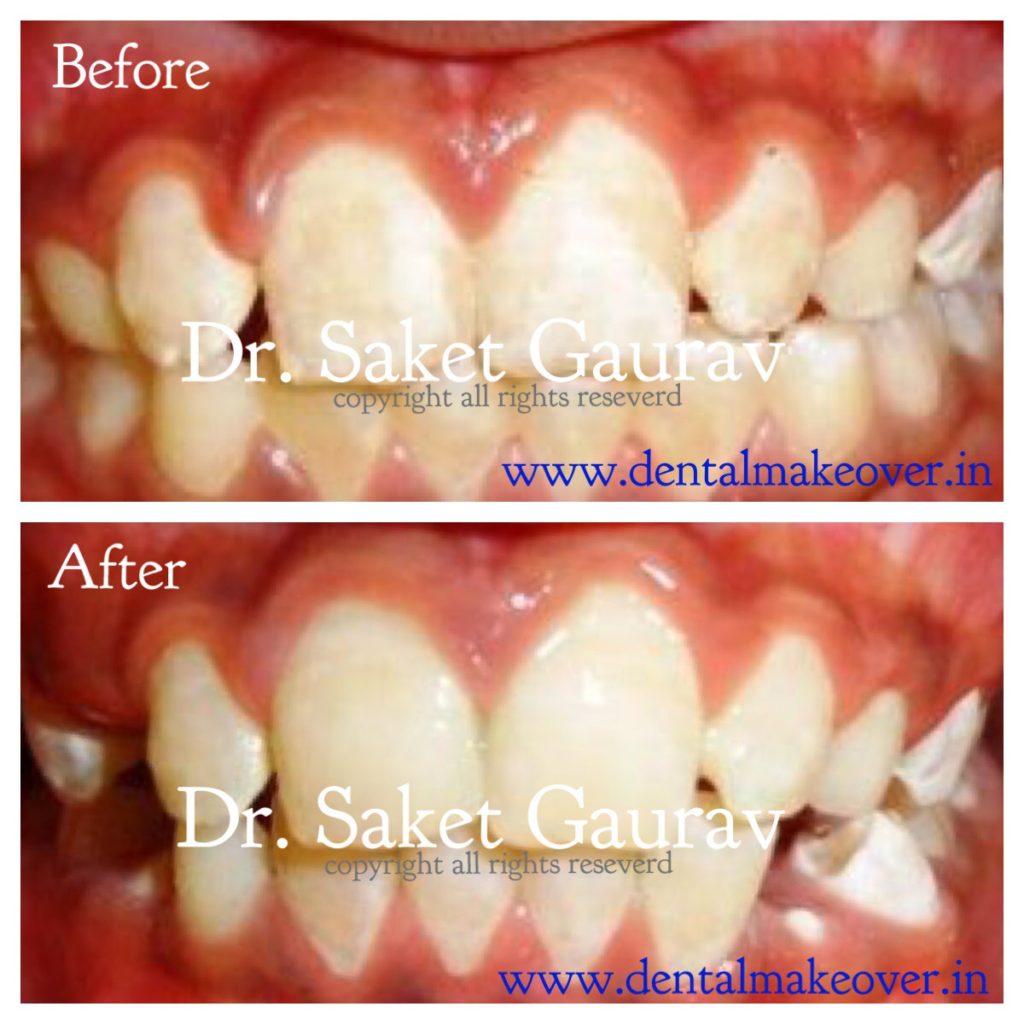 Invisalign aligners for teeth straightening at Dental Makeover Indirapuram