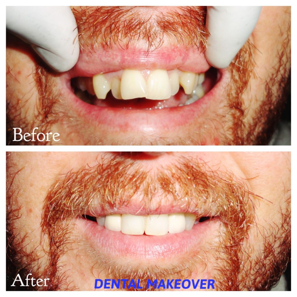 Closeup of a bright white smile after teeth whitening in Indirapuram