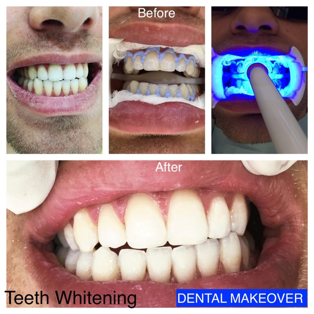 Professional teeth whitening session by Dr Saket in Ghaziabad