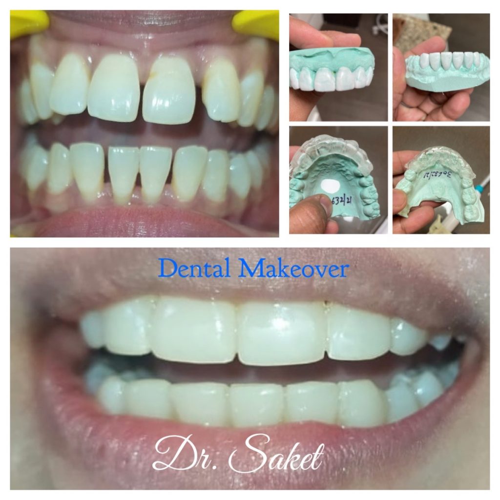 Patient getting cosmetic dental veneers for a perfect smile in Indirapuram