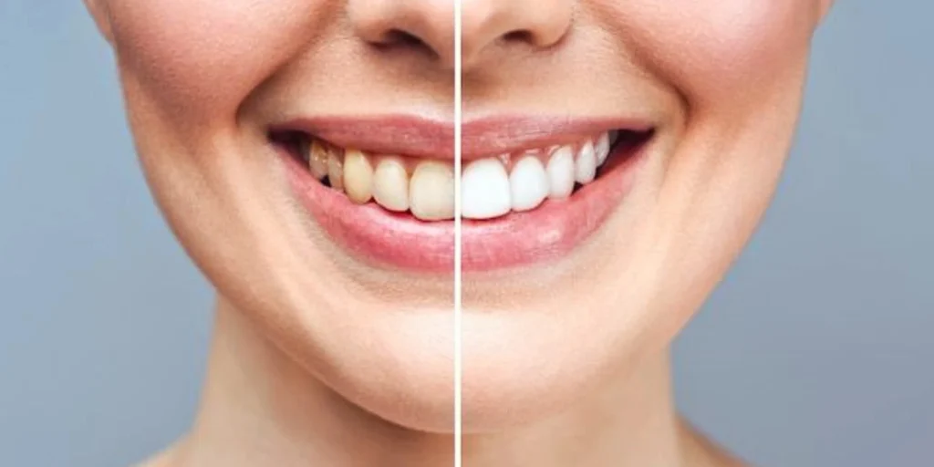 Comprehensive dental services in Indirapuram including crowns, bridges, Invisalign braces, and smile makeovers