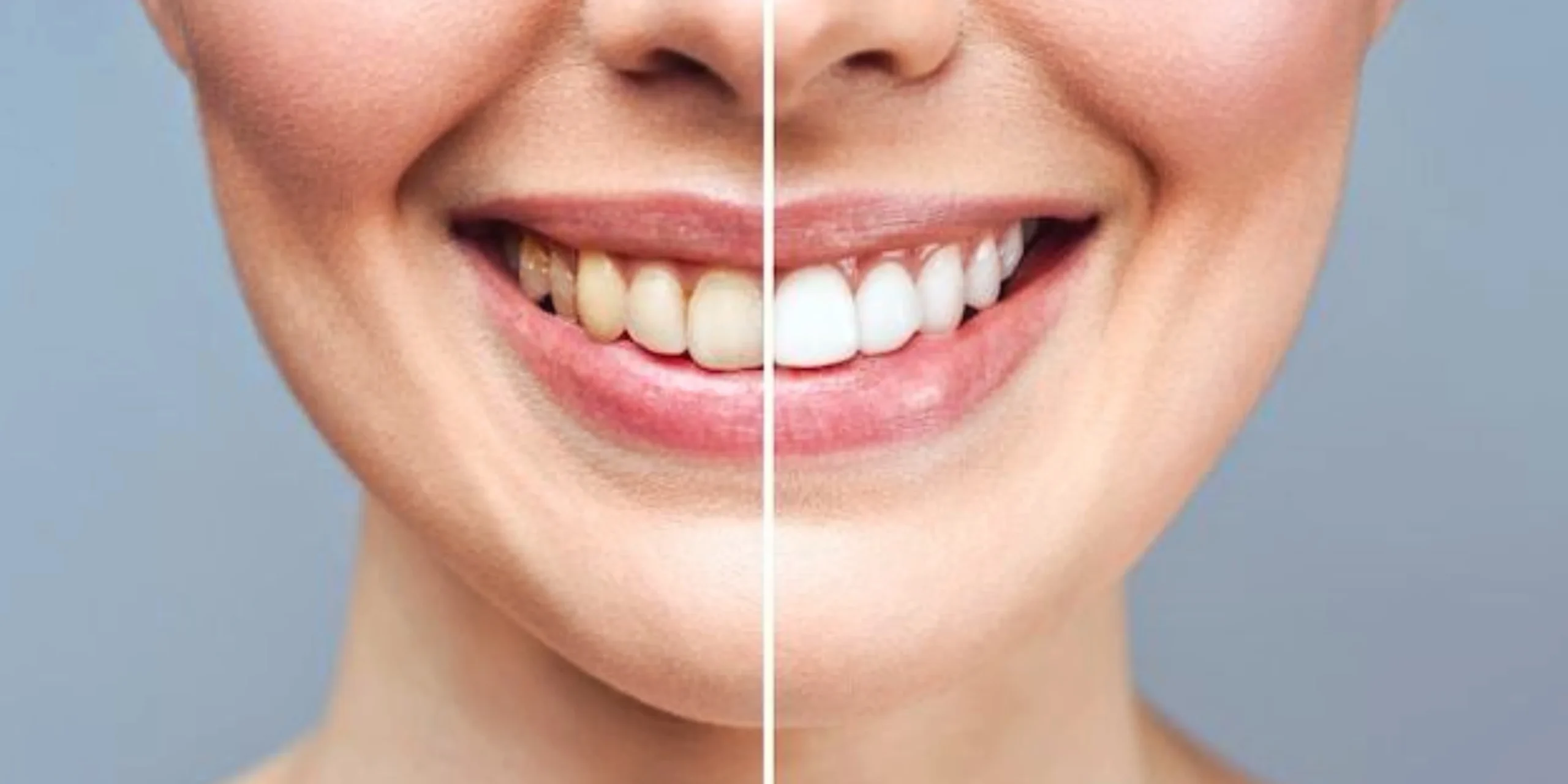 Before & After Smile Makeovers | Best Dentist in Indirapuram – Dr. Saket