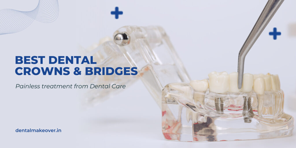best-dentist-in-ghaziabad-for-crowns-and-bridges