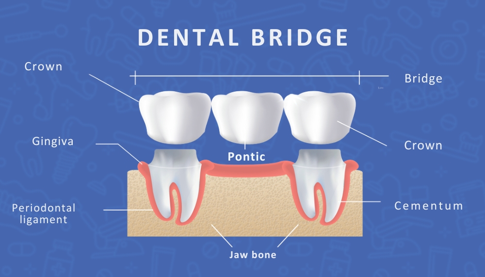 best-dentist-near-me-dental-crowns-ghaziabad