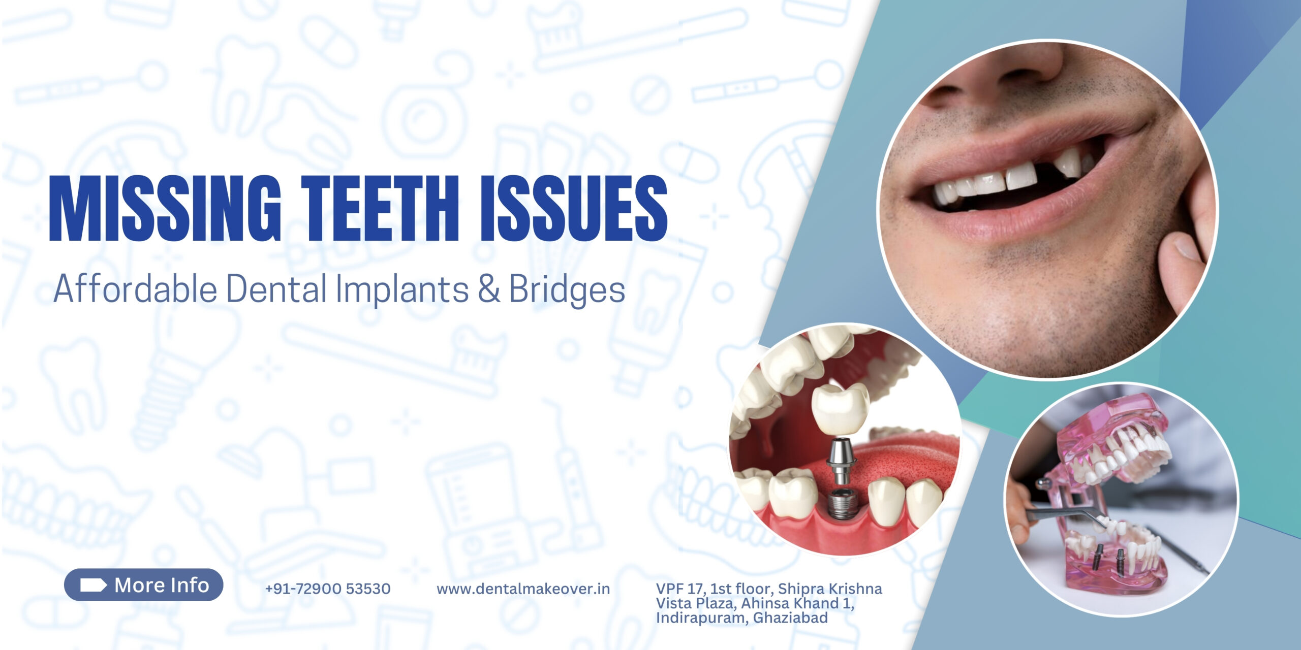 Missing Teeth Issues | Affordable Dental Implants & Bridges