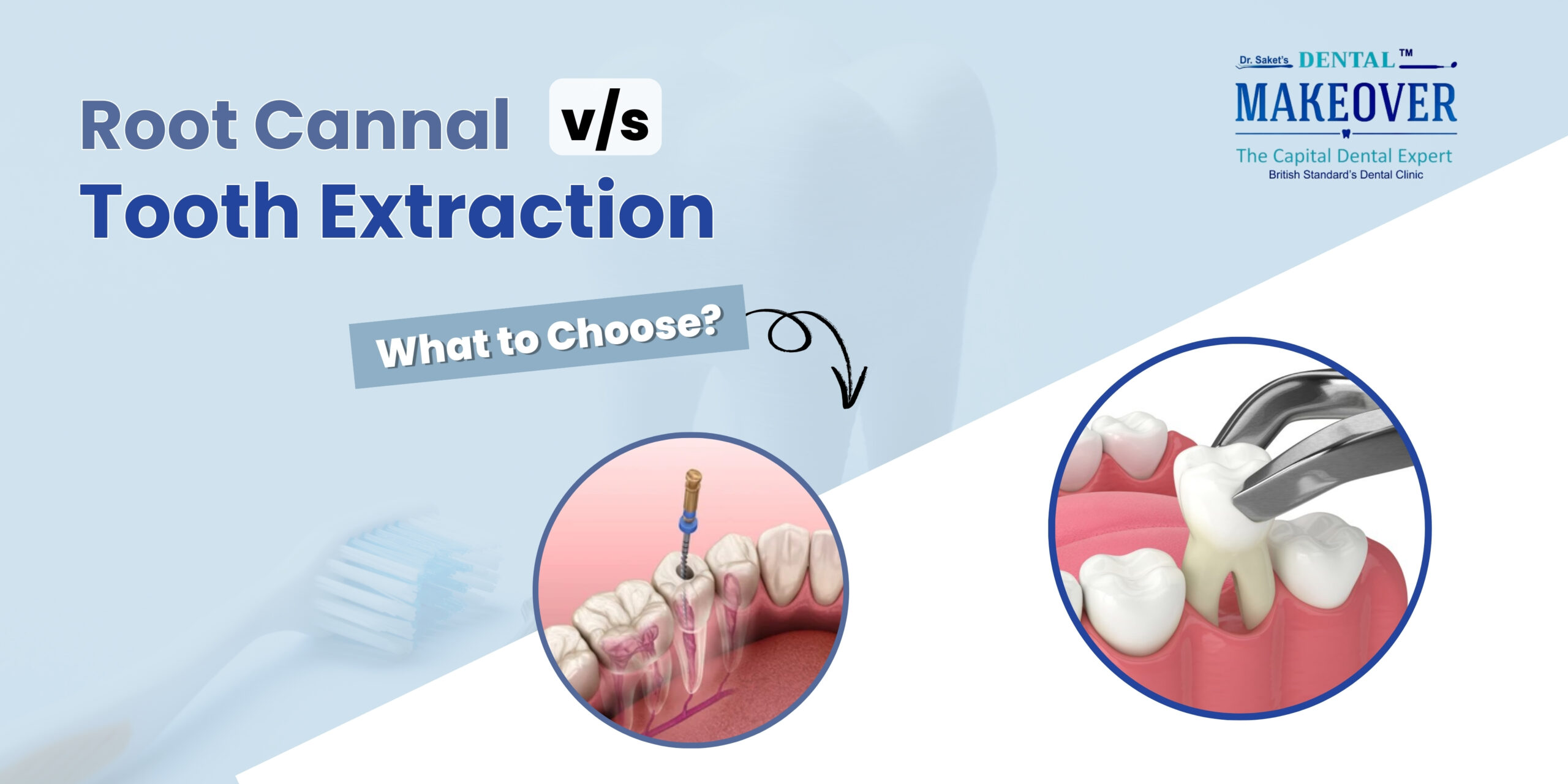 Root Canal vs Tooth Extraction | Expert Dental Care