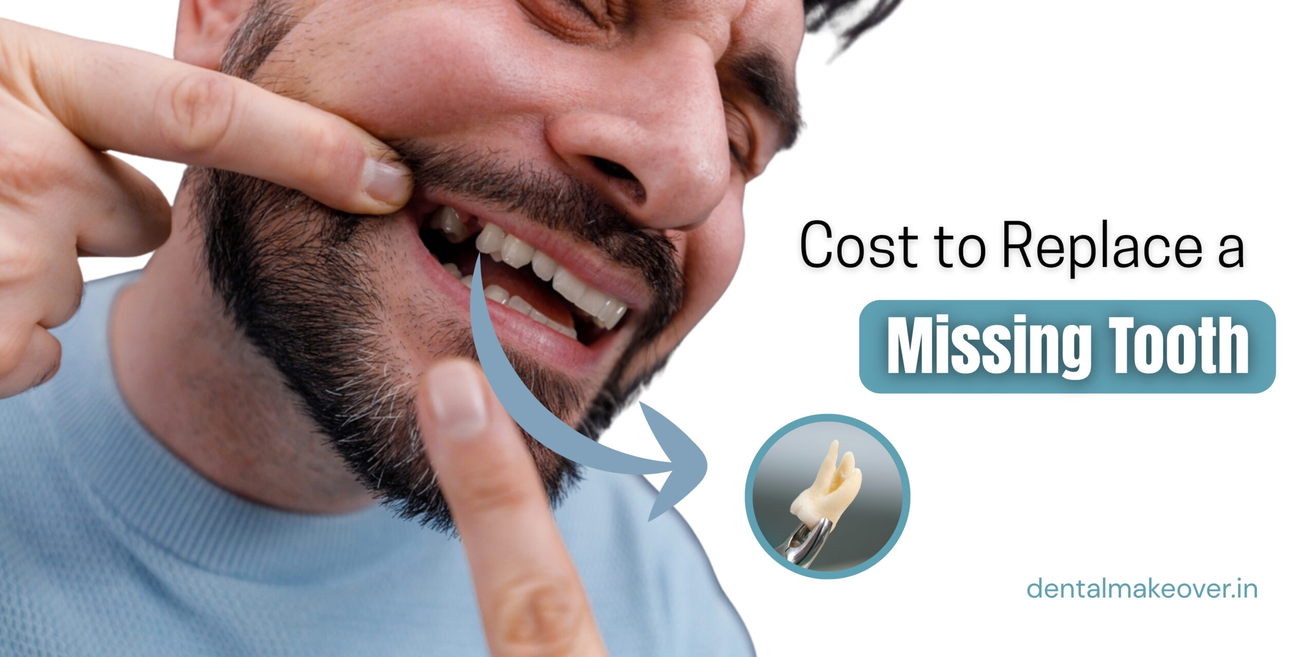 What’s the Cost to Replace a Missing Tooth in Indirapuram? Get Full Guide