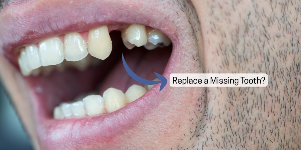 patient-learning-cost-to-replace-a-missing-tooth-with-dental-implants-and-bridges-in-indirapuram