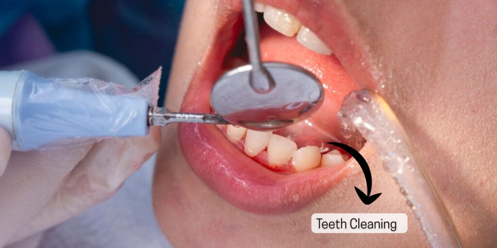 patient-receiving-professional-teeth-cleaning-at-dental-clinic-in-indirapuram-by-best-dentist-in-ghaziabad