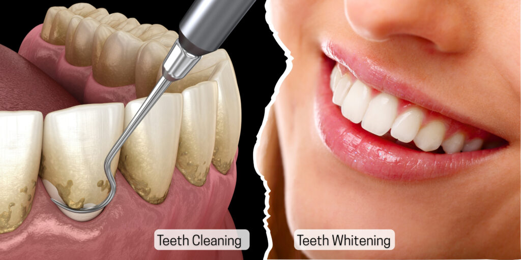 Patient-undergoing-teeth-cleaning-vs-whitening-procedure-with-best-dentist-in-indirapuram
