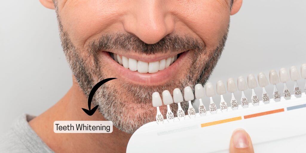 smile-enhancement-with-teeth-whitening-treatment-at-dental-clinic-in-indirapuram-for-brighter-white-teeth