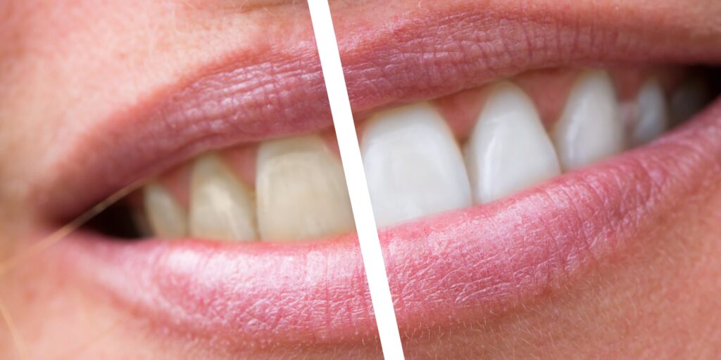 patient-getting-professional-teeth-whitening-treatment-to-get-rid-of-yellow-teeth-fast-at-dental-clinic-in-indirapuram
