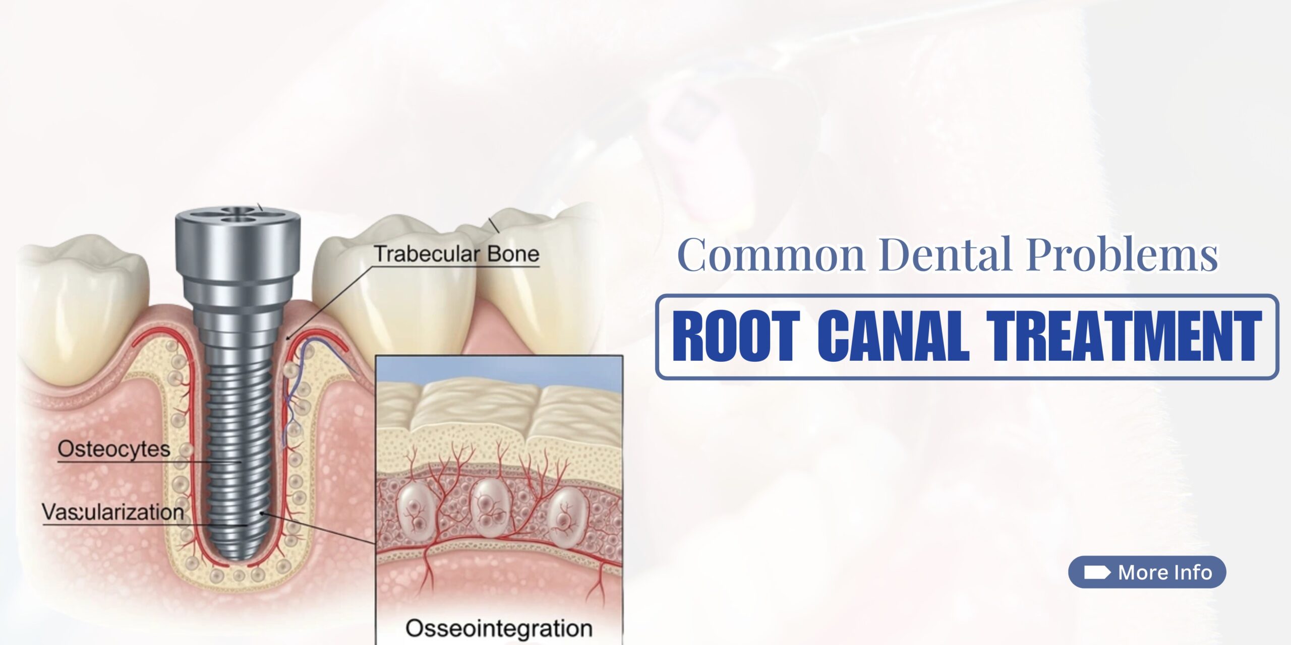 Root Canal Treatment: Expert Solution for Cavities and Infection