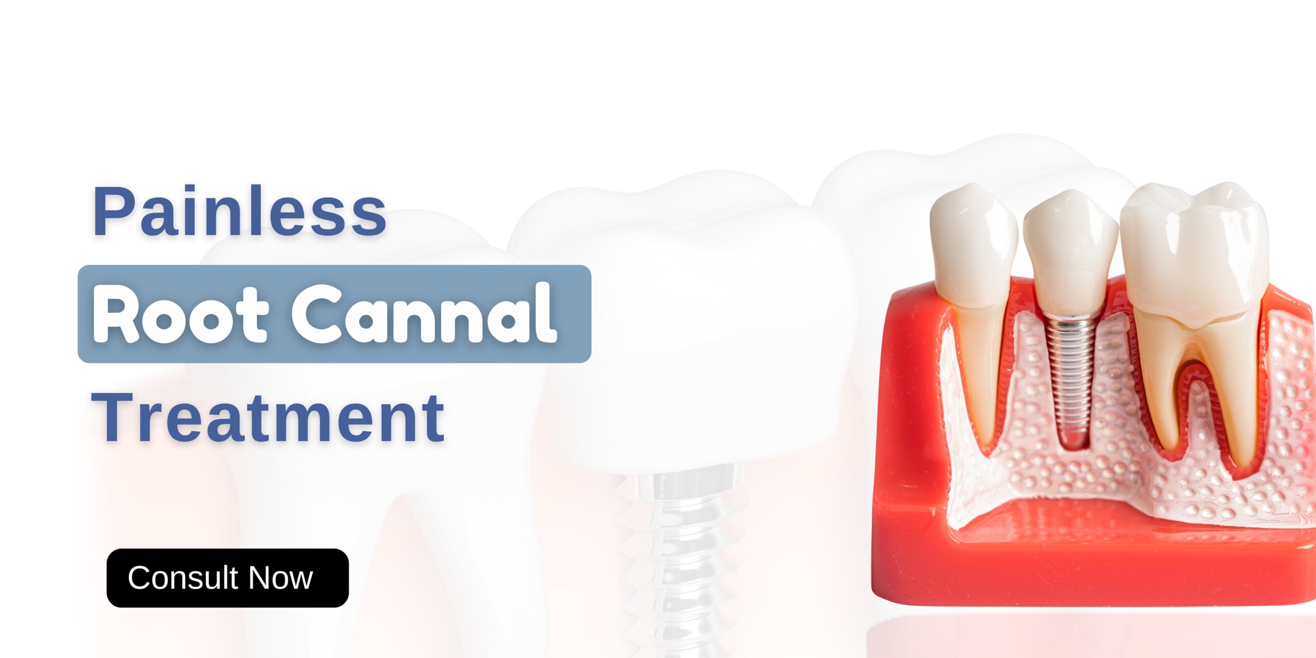 Root Canal Treatment in Noida – Save Your Tooth with Expert Care