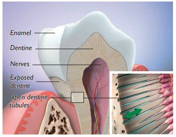 tooth-sensitivity-dentin-exposure-nerve-pain-diagram