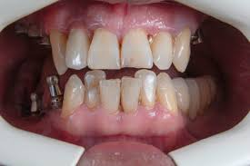 common-causes-teeth-sensitive-cold-enamel-wear-gum-recession